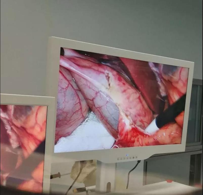 32 inch 3 d medical grade monitor for surgery images