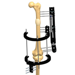 Prevention of knee subluxation with the LRS Fixator and Sheffield Ring Fixator, during lengthening of the femur.