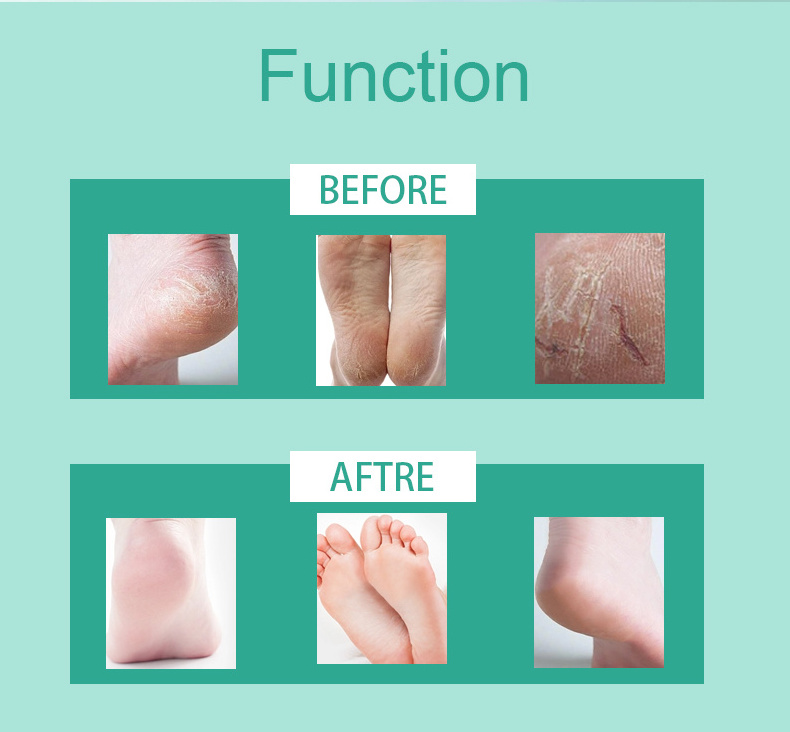 Foot Skin Care Exfoliator Peel Off Calluses Dead Skin Callus Remover