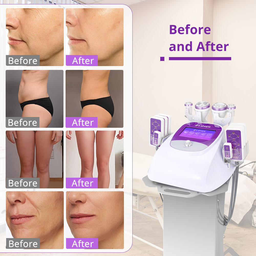 Aristorm Fat Cavitation Machine S Shape 30k Lipolasers 160mw Body Contouring Face Lifting Cavitation EL EMS RF Machine