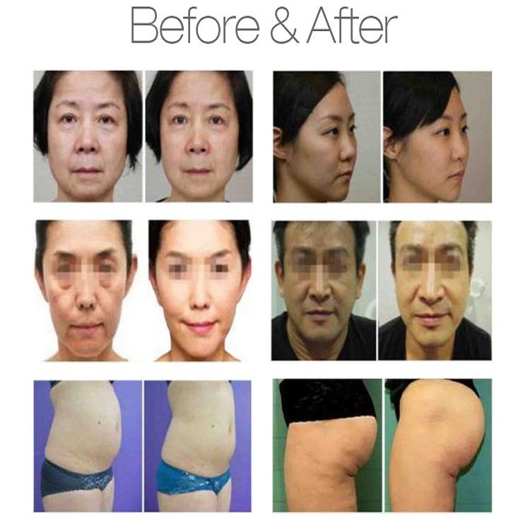 Svatar Esthetic Body Shaping Sculpting Slimming Skin Tightening And Lifting Device Vertical Liposonic Machine