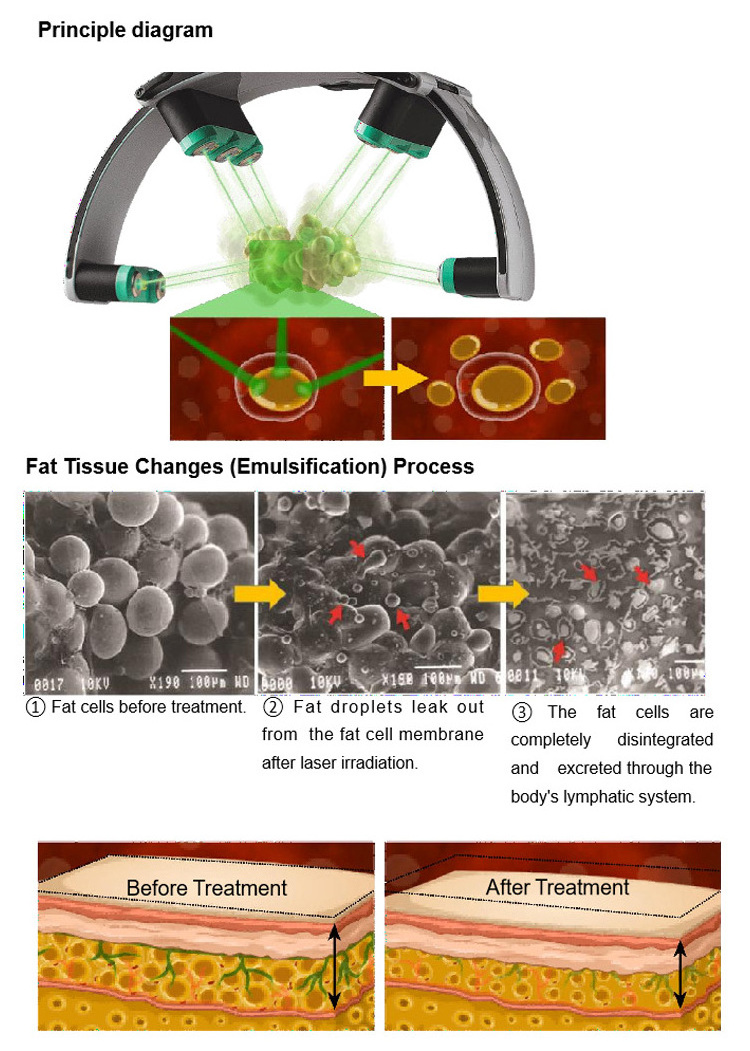 10D Green Laser Maxlipo Master Light Lipo Therapy Fat Burn Weight loss Cellulite Body Slimming Lipo Machine