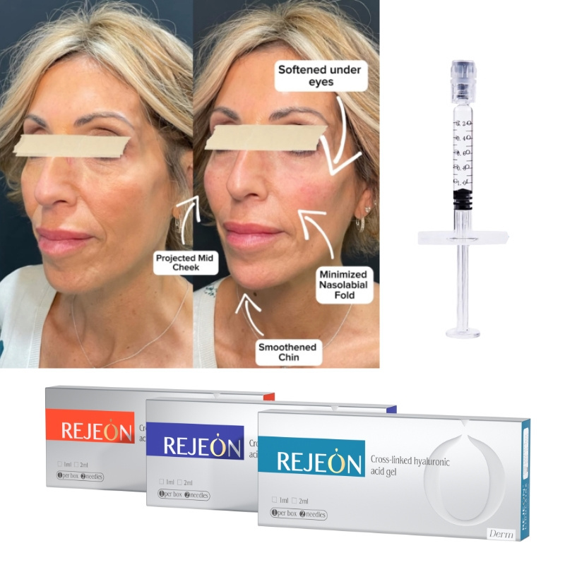 REJEON Cross Linked 3ml Dermal Filler Hyaluronic Acid Injectable Body Filler Injection For Face