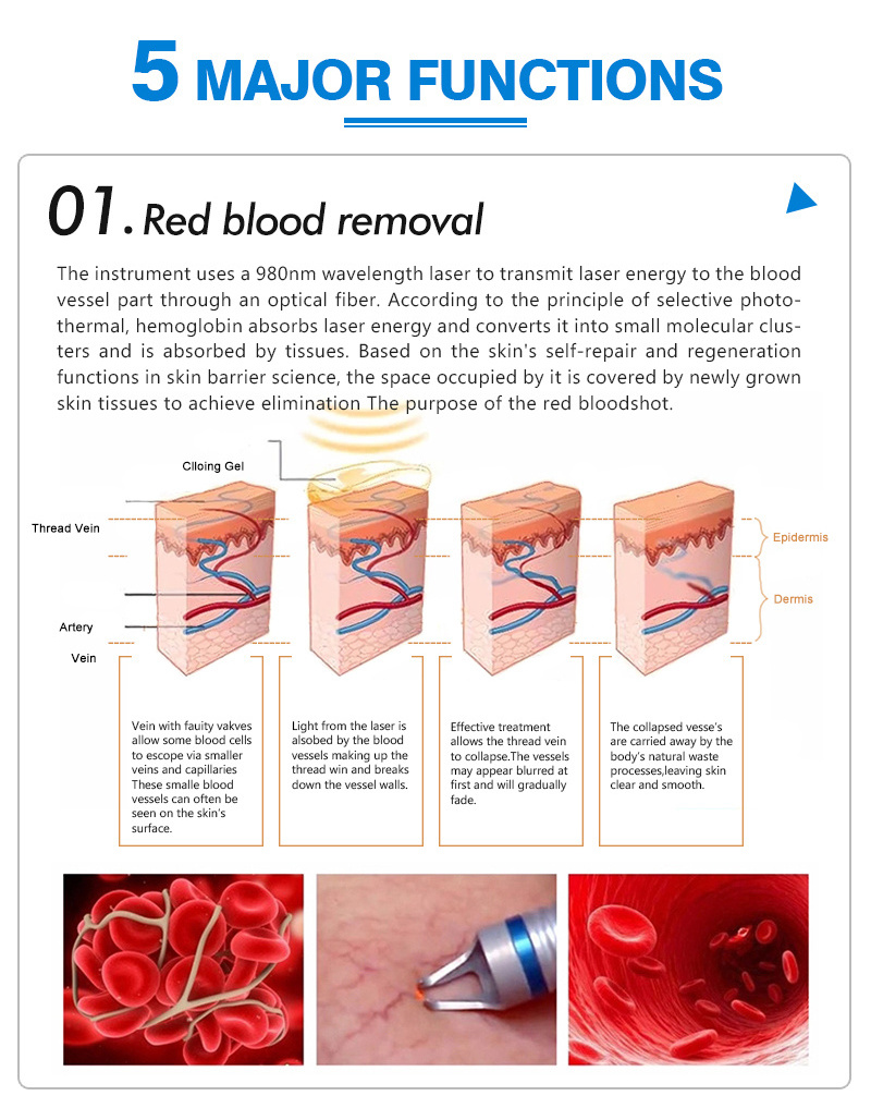 60W  980nm Diode Laser/980nm Diode Laser Spider Vein Removal Machine/Laser Invisvel 980nm Beauty Equipment