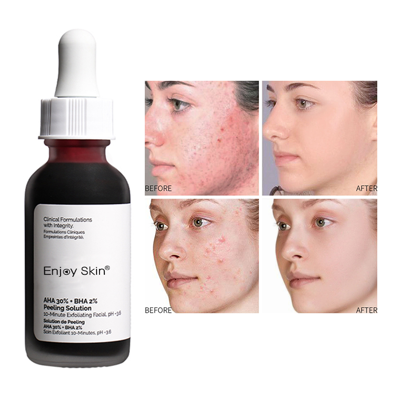 Enjoy Skin Private Label AHA BHA Peeling Solution Face Serum Anti Acne Exfoliate Renew Face Skin  Factory Price