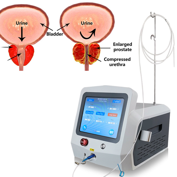 Diode Laser Machine 980nm 1470nm Potent Medical Therapy Prostate Urology Surgery For BPH