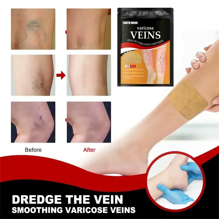 Wholesale treating varicose veins naturally varicose veins care Removal Leg Plaster Treatment Varicose Vein Patch