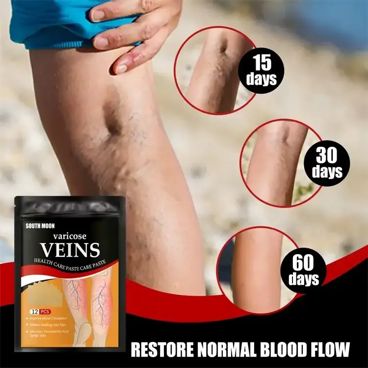 Wholesale treating varicose veins naturally varicose veins care Removal Leg Plaster Treatment Varicose Vein Patch