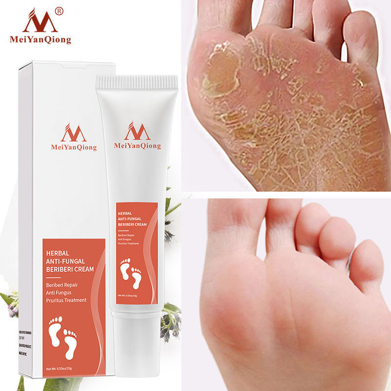 tiktok Hot Anti Fungal Nourishing Relieve Beriberi Treatment Cream Exfoliating Smooth Nail Repair Cream