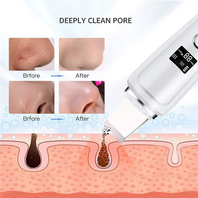 Comedones Extractor Deep Cleansing Skin Spatula Pore Cleaner Ultrasonic Facial Scrubber