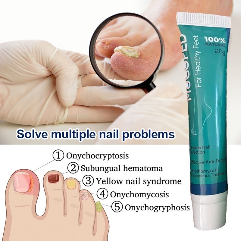 OEM Fungal Nail Repair Cream Hand Foot Anti Infection Paronychia Onychomycosis Treatment Nail Care Ointment ODM