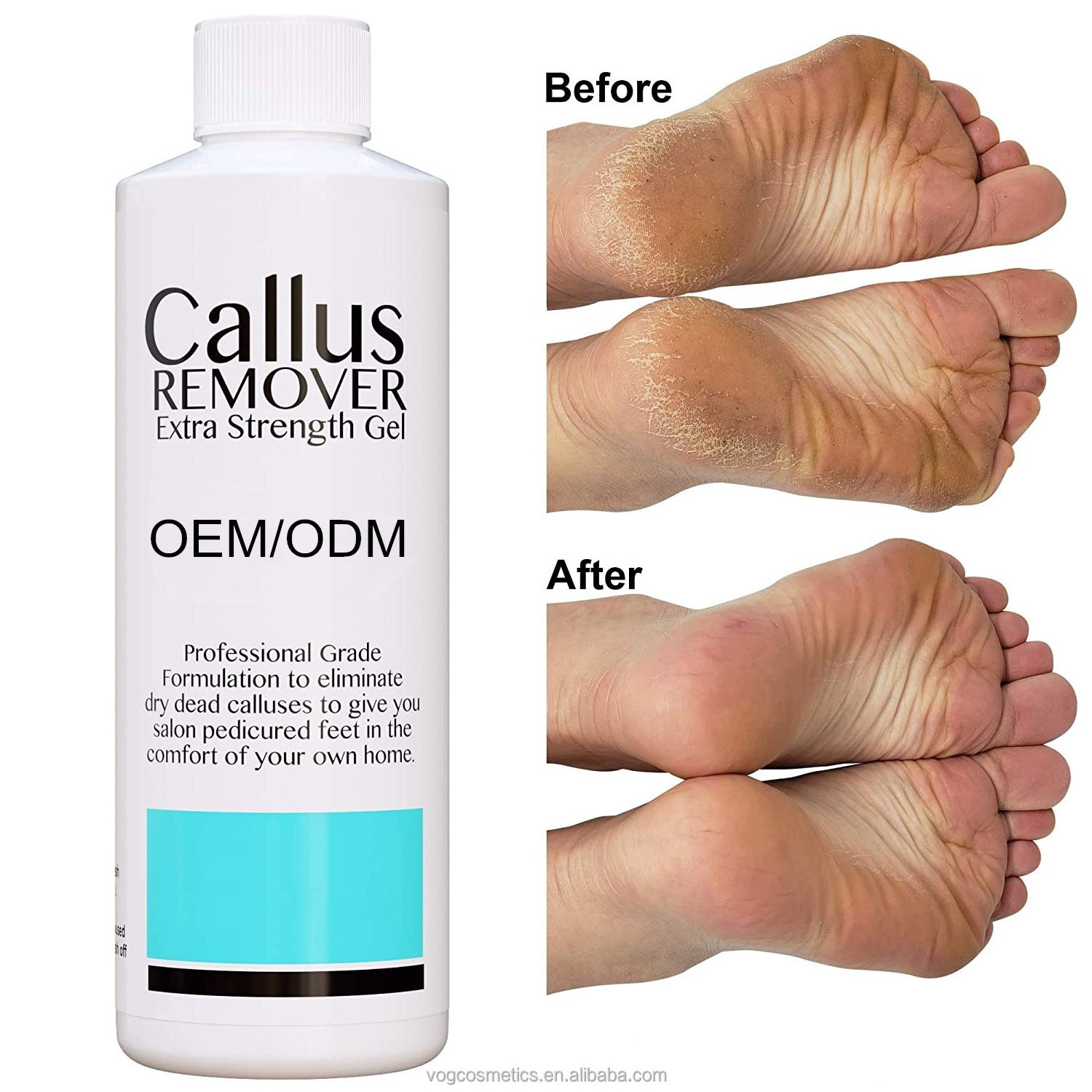 Private Label Foot Callus Remover Gel Exfoliator & Dead Skin Remover Callus Remover For Feet & Cracked Heel Repair Gel