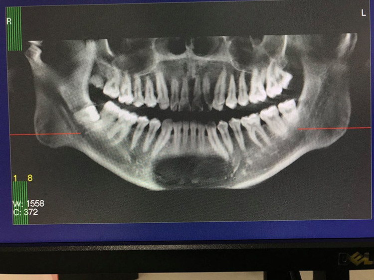 High resolution digital panoramic dental x-ray machine,dental CBCT