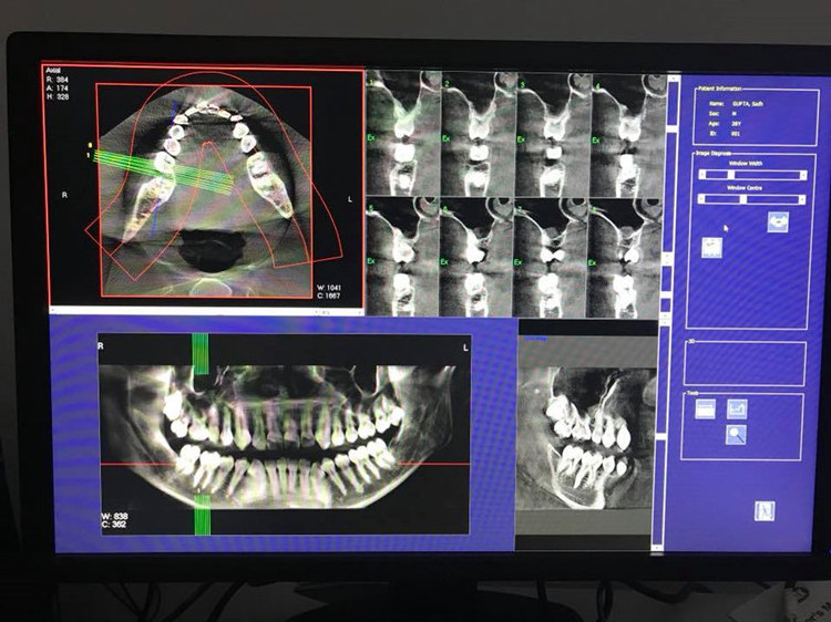 High resolution digital panoramic dental x-ray machine,dental CBCT