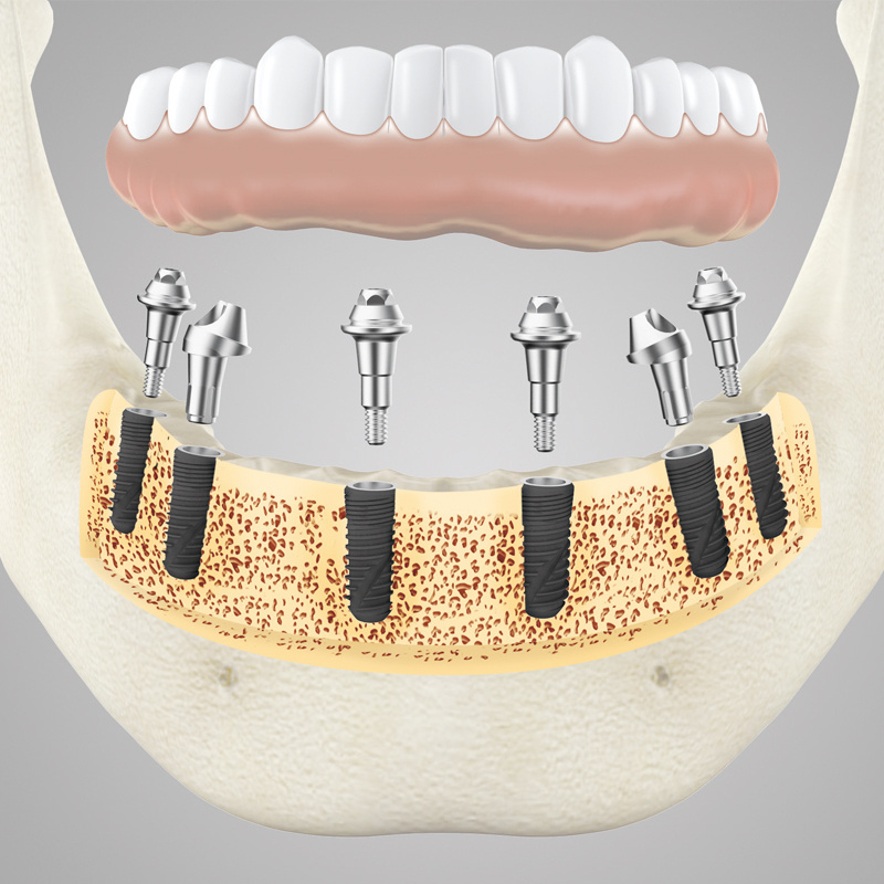 WEGO medical manufacturer dental implant abutment solid abutment