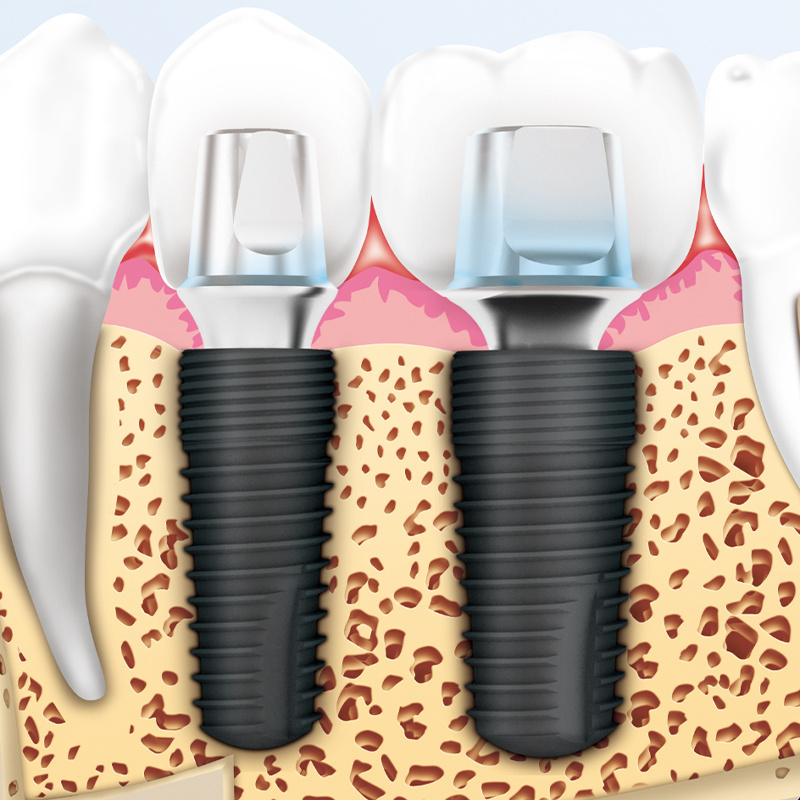 Implant dental System S.L.A Surface Pure Titanium Surgical Kit Abutment Dental Implant