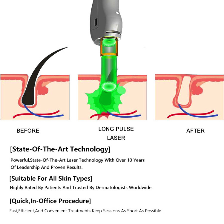 2024 Ce Rohs Long Pulse Alexandrite Laser Hair Removal Machine Price With Cooling Nd Yag 755Nm 1064Nm Alex Laser