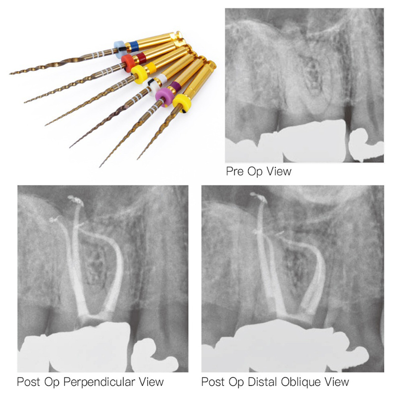 dental endo root canal hand rotary k files