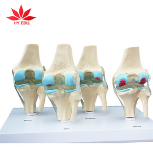 High quality PVC Transparent human Stage 4 knee joint model for studying