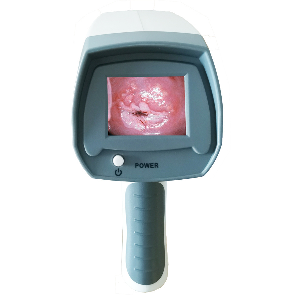 Colposcopy vagina digital electronic Video Colposcope camera for vagina detection