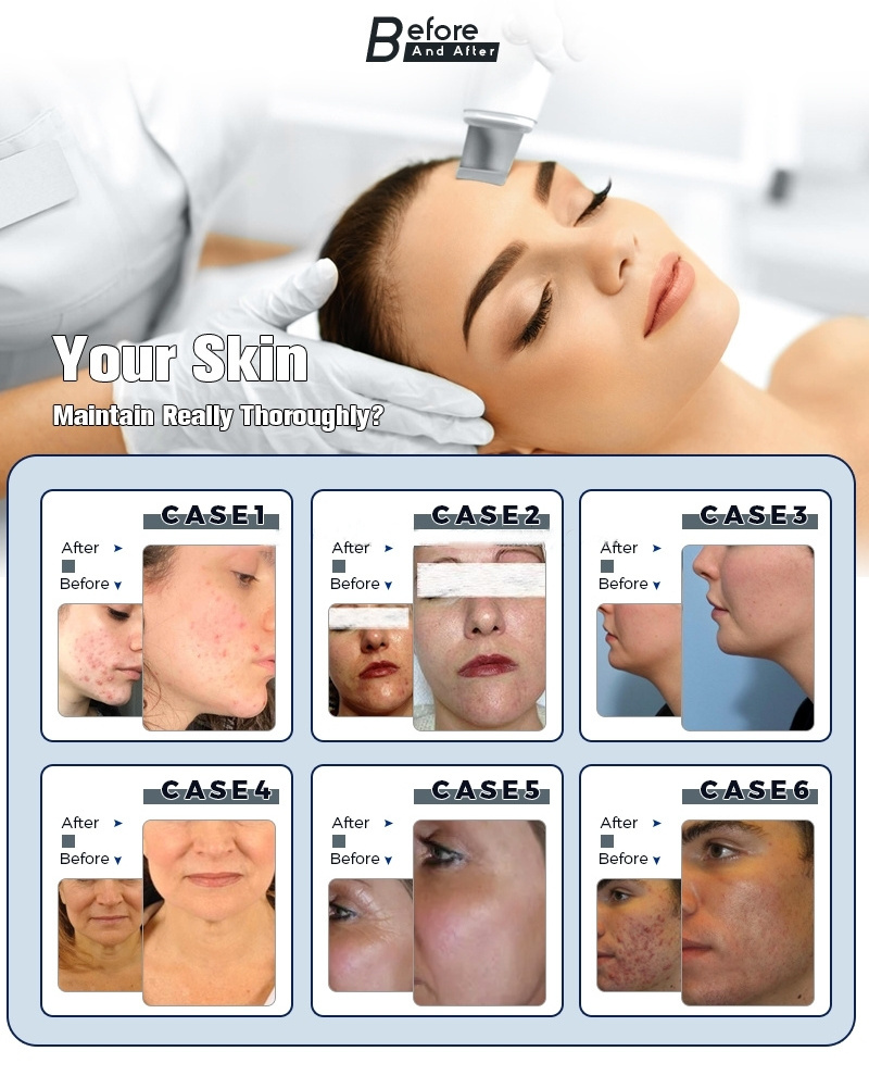 Professional 14 In 1 Aqua Peeling Machine Hydra Oxygen Facial Diamond Dermabrasion Machine Hydro Facials Machine