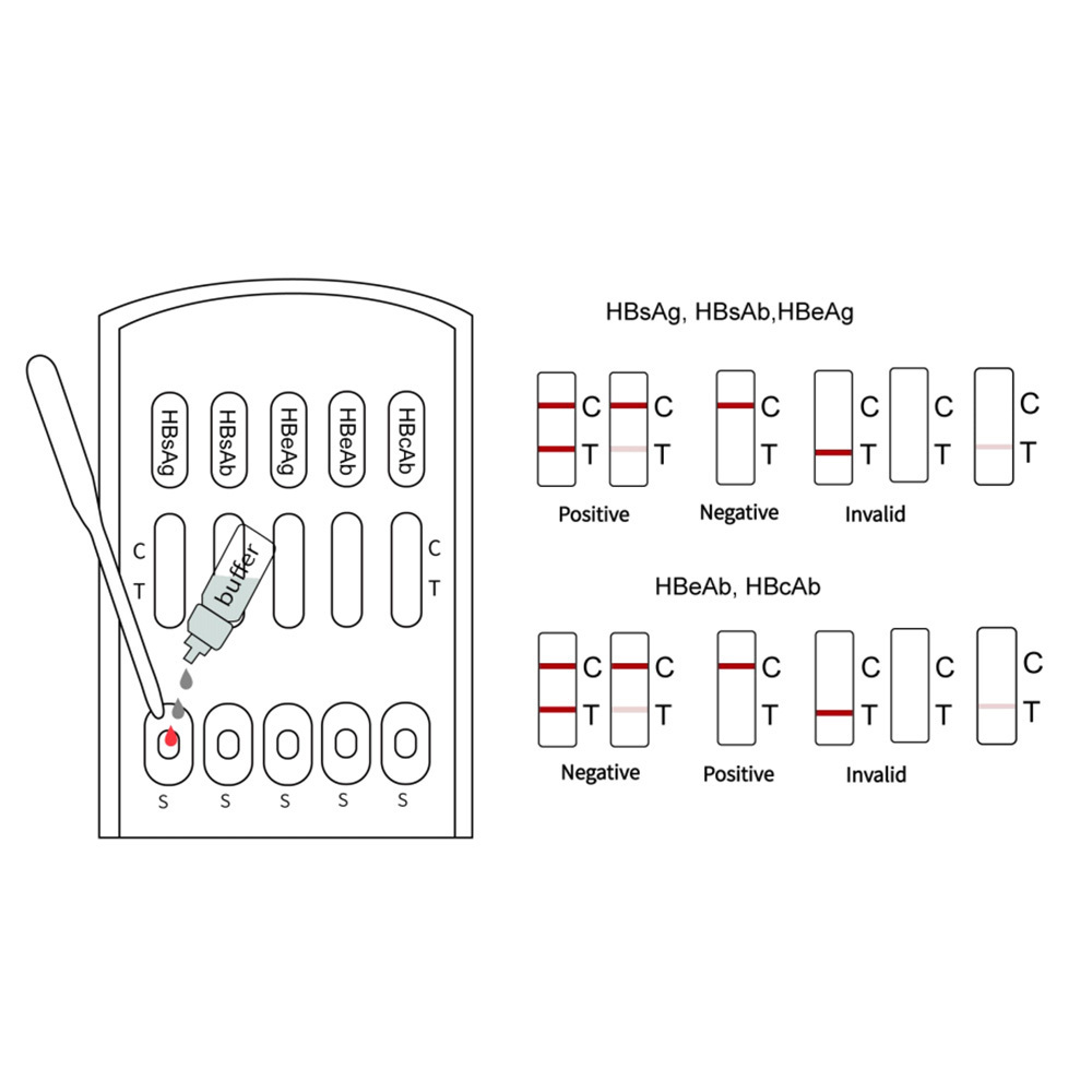 High-end Factory Supply HBsAg HBsAb HBeAg HBeAb HBcAb 5 in 1 HBV Combo Test  Analysis