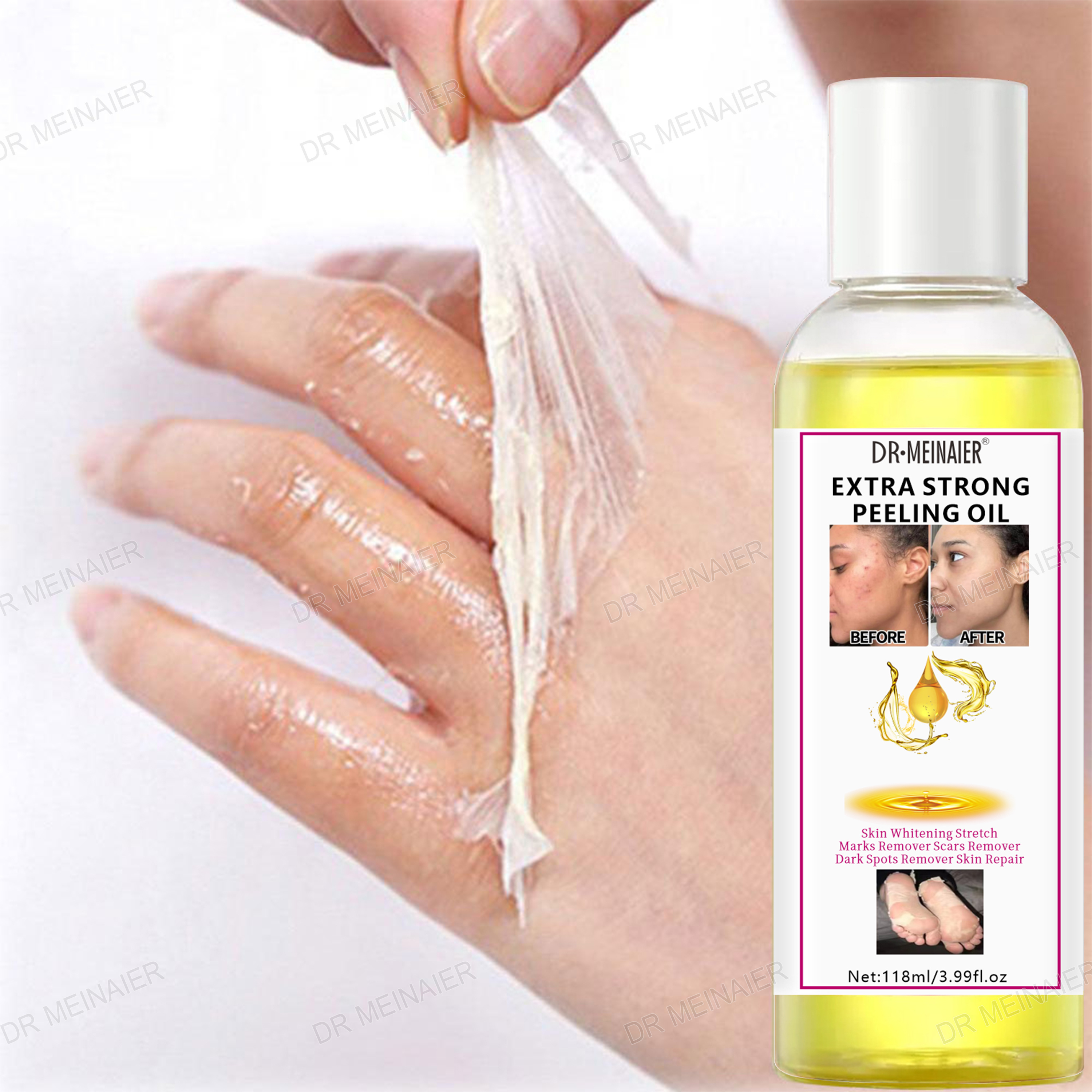 Strong Peeling Oil Whitening Skin Tone Knuckle Spots Remover Brightening Extra Strength Yellow Peeling Oil Dark Skin Corrector