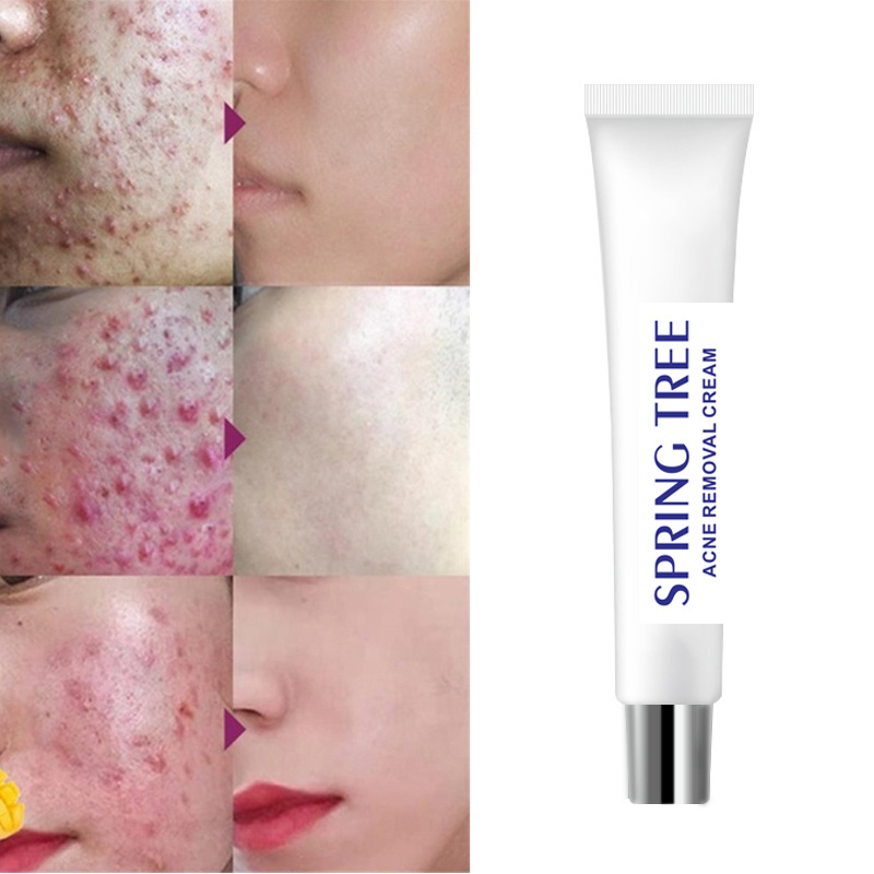 Light Print Scars Removal Face Cream Beauty Pure Skin Care Whitening Facial Moisturizing Cream Acne Treatment Cream