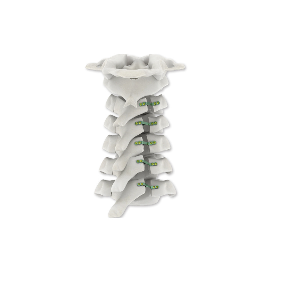 Choose Ha2.0 Fixed Screws Single Eagle LaminarShapping Plate Spinal Implants Used For Cervical Decompression Fixation