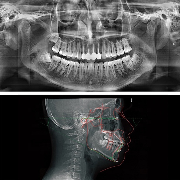 Dental Equipment Panorama Cephalometric Xray Unit Rayos X Periapical Digital 3D X Ray Machine OPG CBCT Panoramic Dental X-ray