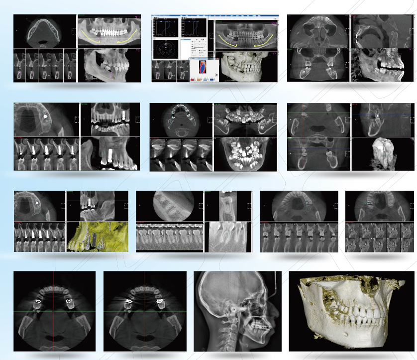 3D Panoramic and Cephalometric Dental X-ray Machine YSX1005E with  3D CBCT