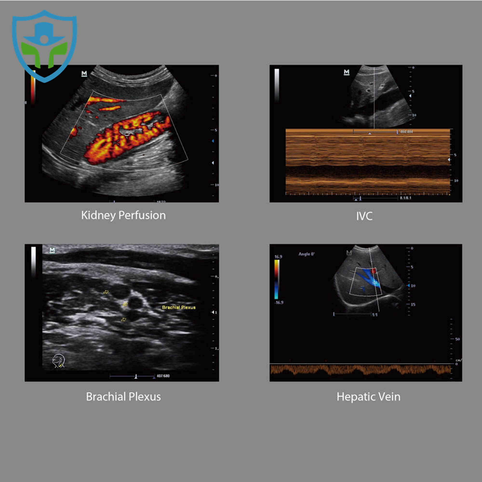 Mindray M6 Ultrasound Machine Portable Color Doppler Human Ultrasound Gynecology USG Machine