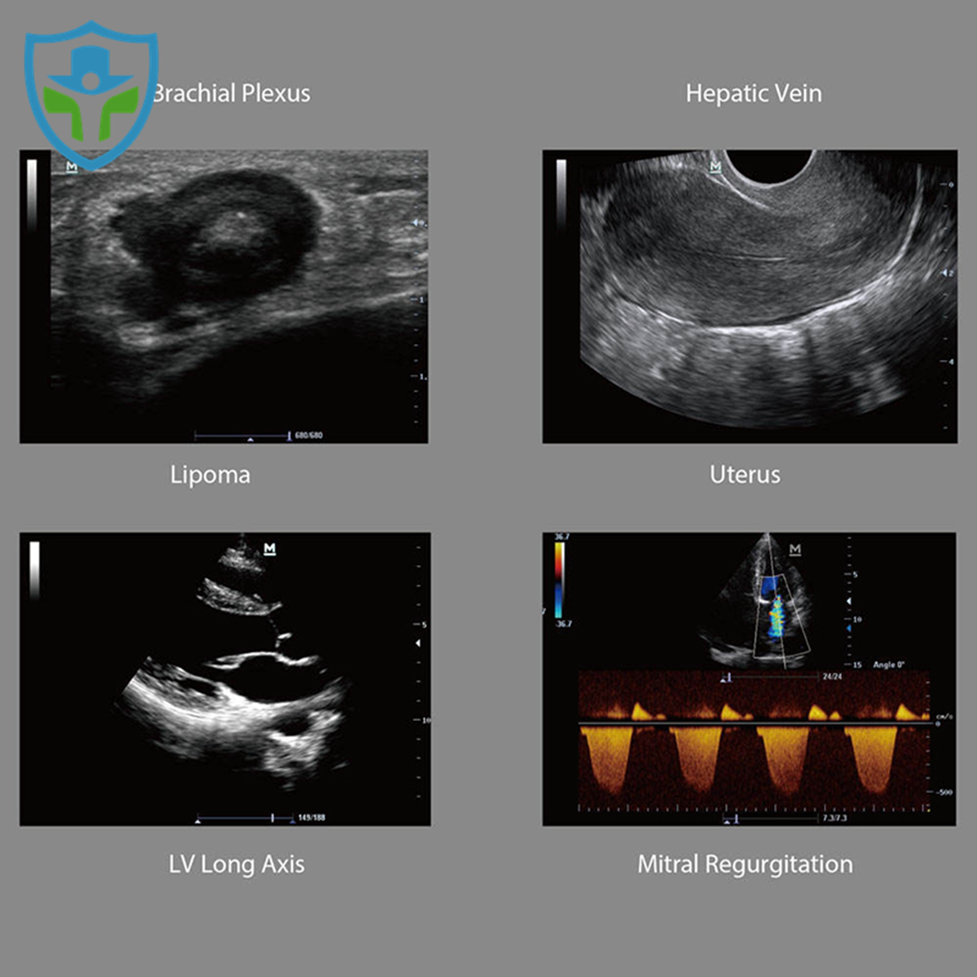 Mindray M6 Ultrasound Machine Portable Color Doppler Human Ultrasound Gynecology USG Machine