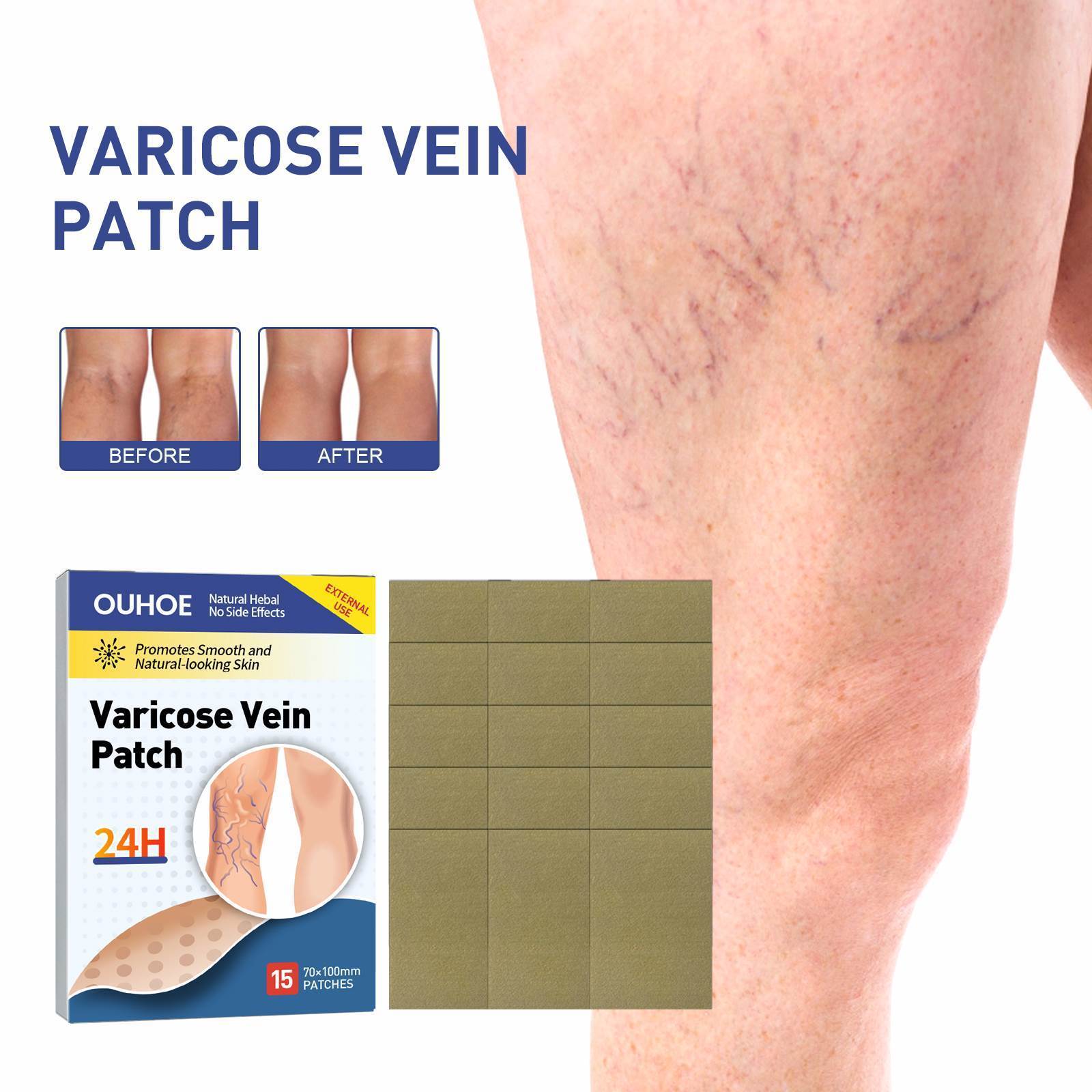 Ouhoe New Cheap Cost 15pcs Vasculitis Phlebitis Spider Pain Varicose Veins Treatment  Varicose Veins Ointment Herbal  Patch