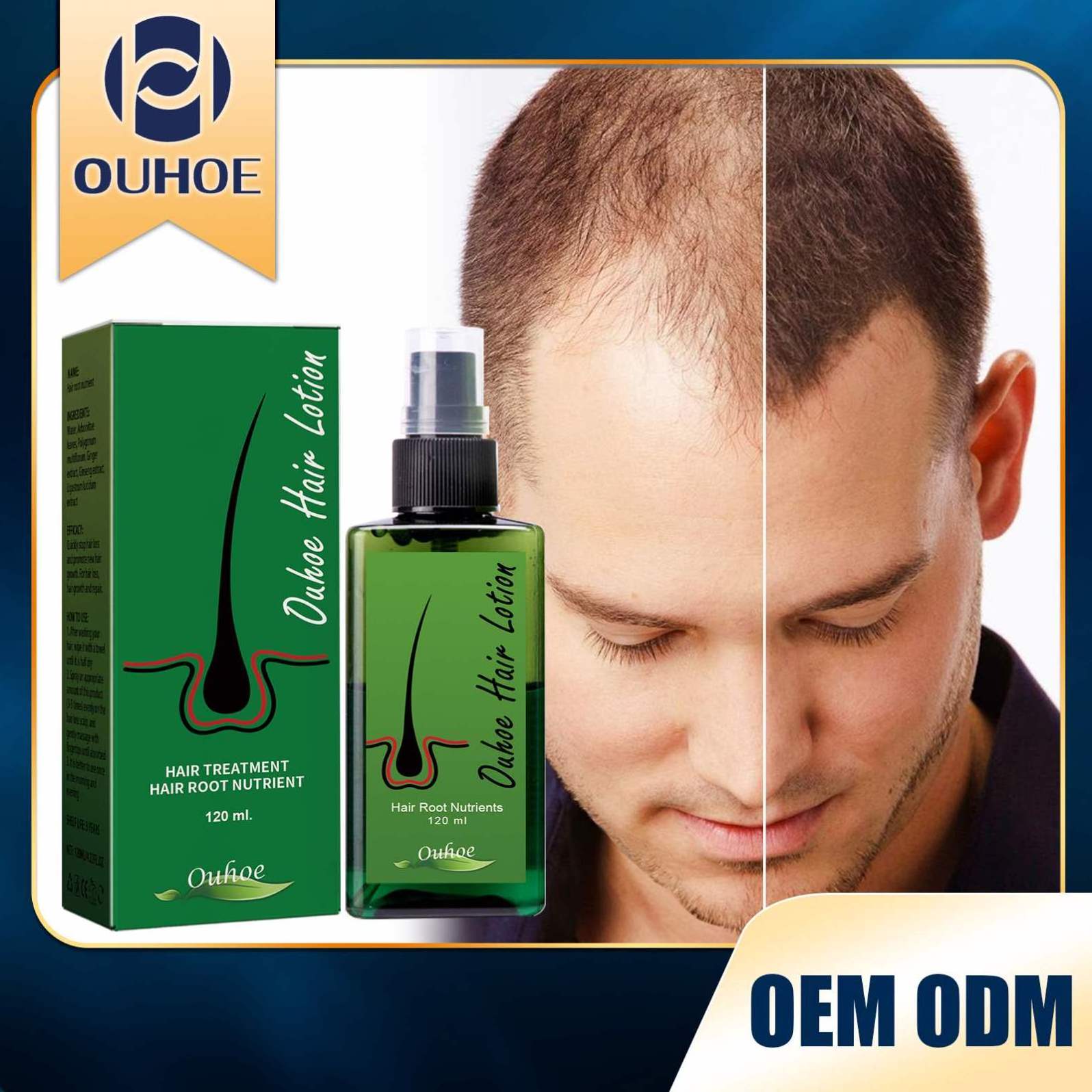 OUHOE Private Label Wholesale  Hair Growth Lotion 120ml  Hair Growth Oil For Men Women   Hair Root Growth