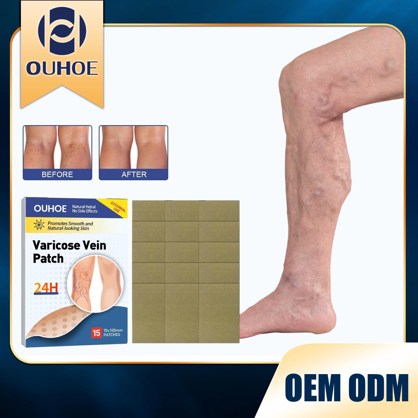 Ouhoe New Cheap Cost 15pcs Vasculitis Phlebitis Spider Pain Varicose Veins Treatment  Varicose Veins Ointment Herbal  Patch