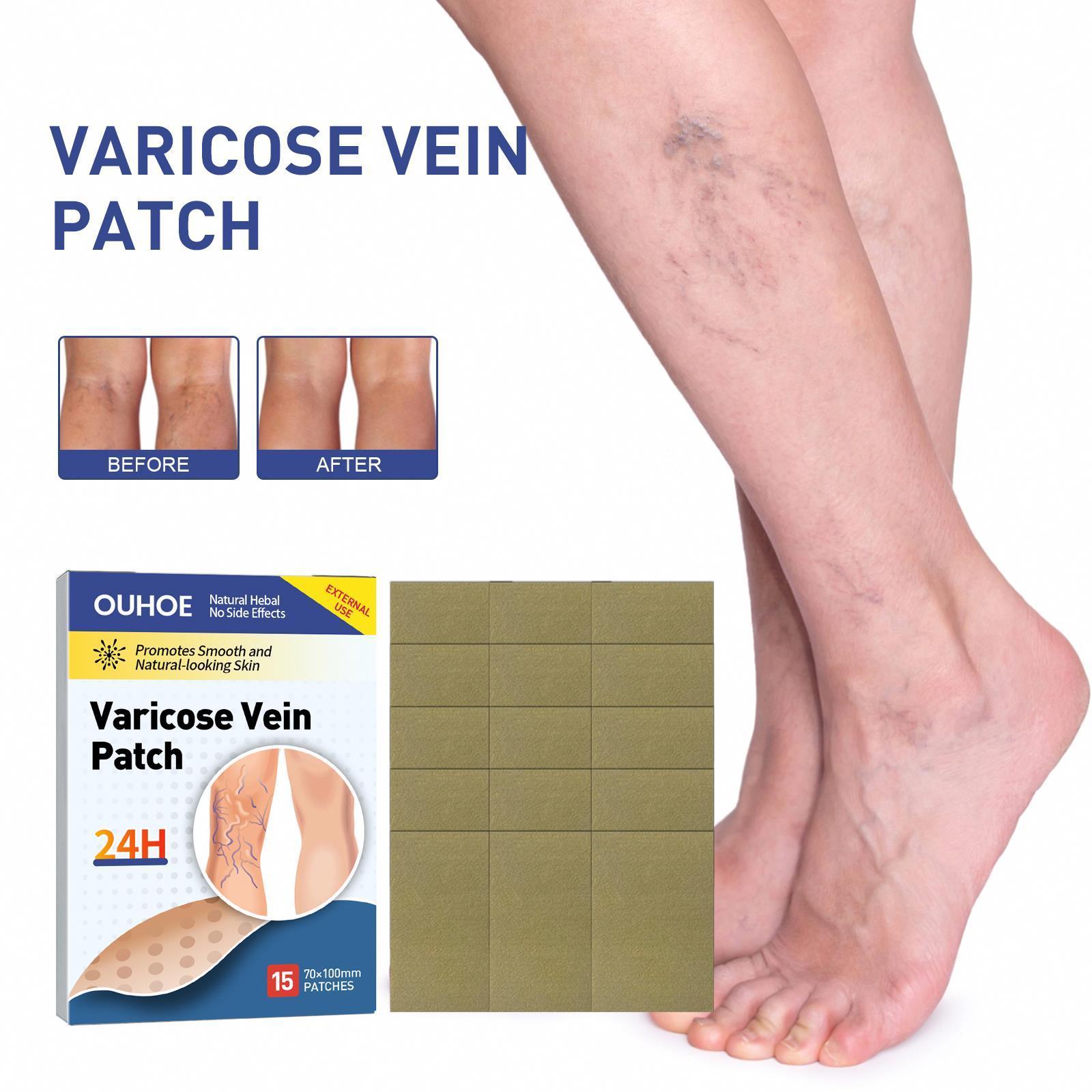 Ouhoe New Cheap Cost 15pcs Vasculitis Phlebitis Spider Pain Varicose Veins Treatment  Varicose Veins Ointment Herbal  Patch