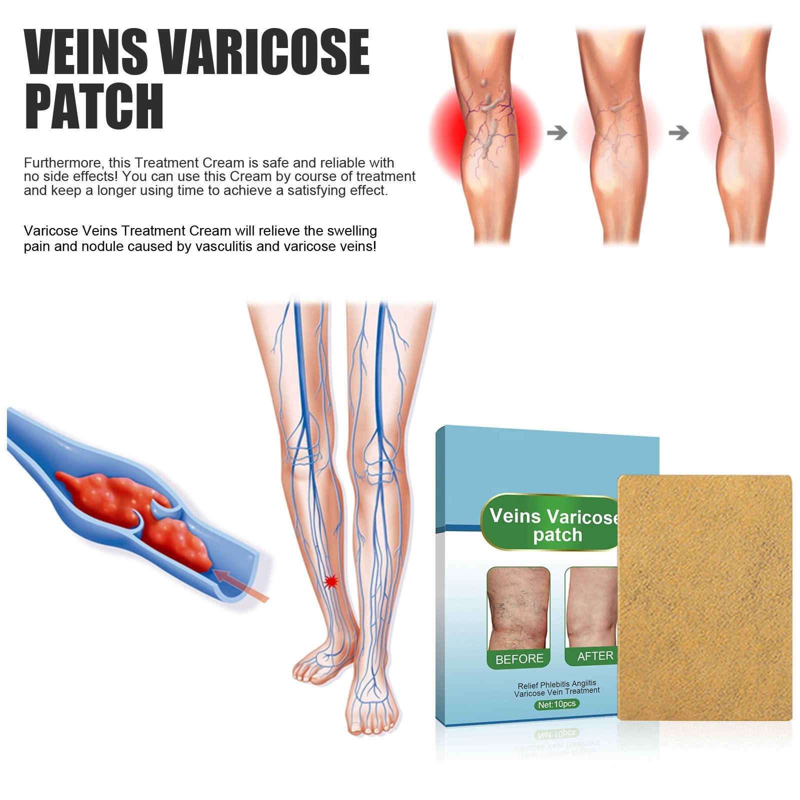 chinese herbal patches for varicose veins leg treatment relieve leg soreness and swelling and remove varicose blood vessels