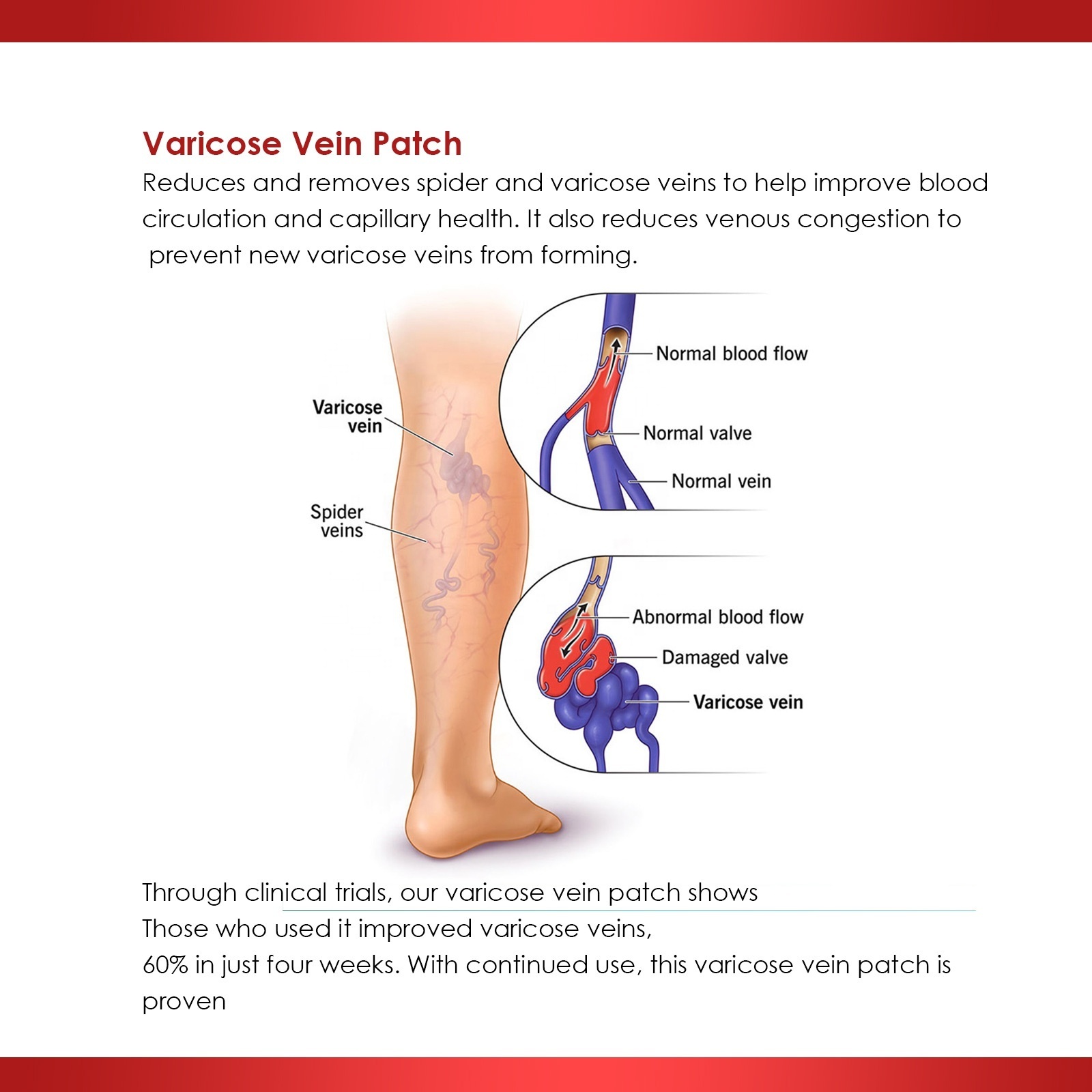 hot sale varicose veins patch for varicose veins remove treatment relieve leg varicose pain earthworm leg