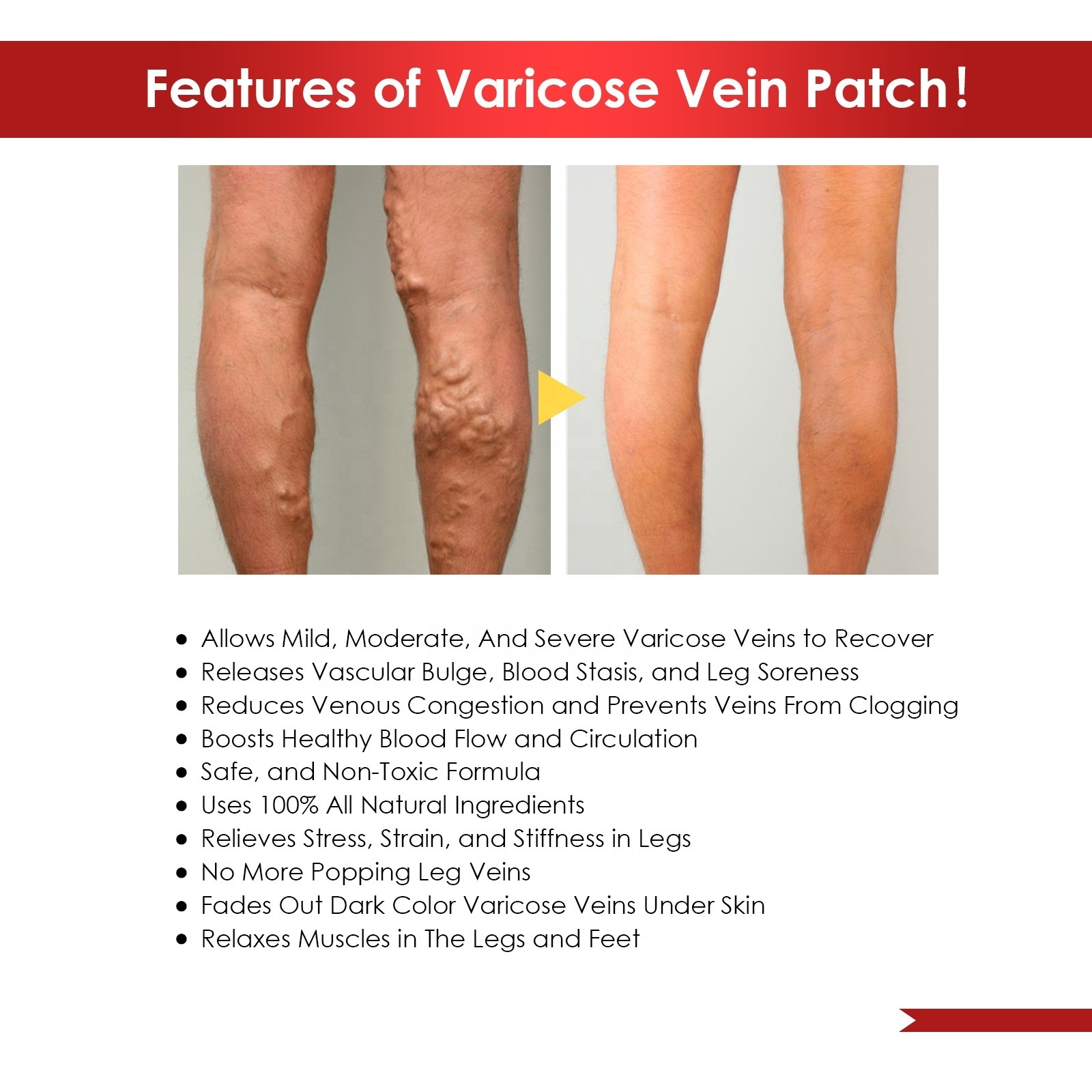 hot sale varicose veins patch for varicose veins remove treatment relieve leg varicose pain earthworm leg