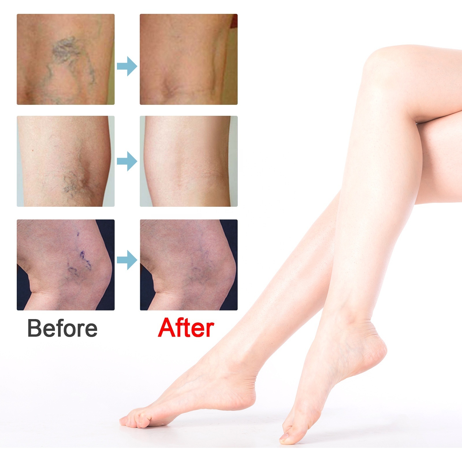 chinese herbal patches for varicose veins leg treatment relieve leg soreness and swelling and remove varicose blood vessels