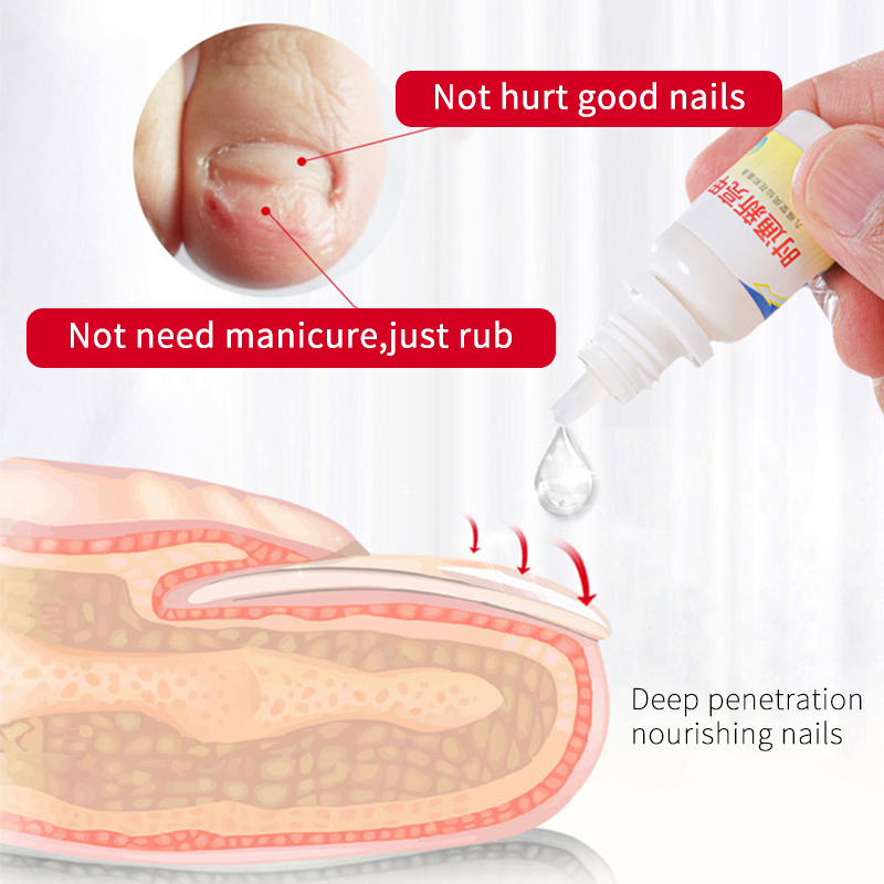 Onychomycosis Care Antifungal from Remover Gel Oil Liquid Adults Nail Fungus Treatment OEM ODM Private Label Hand Skin