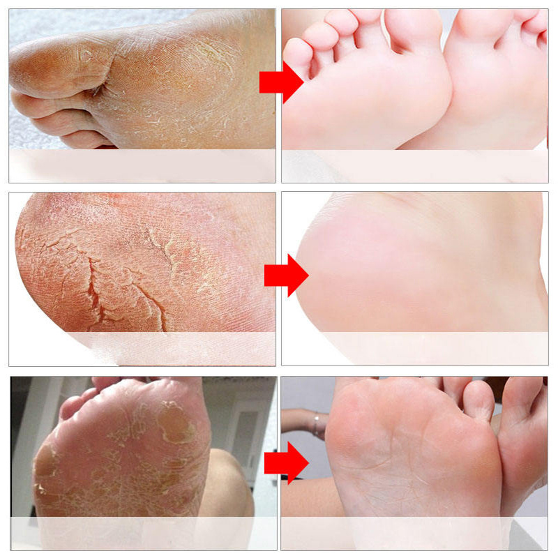 Hot Sale Pedicure Gel Sock Treatment Pedicure Spa Callus Feet Peel Exfoliating Foot Mask